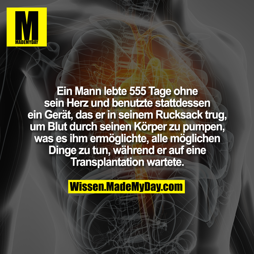 Ein Mann lebte 555 Tage ohne sein Herz und benutzte stattdessen ein Gerät, das er in seinem Rucksack trug, um Blut durch seinen Körper zu pumpen, was es ihm ermöglichte, alle möglichen Dinge zu tun, während er auf eine Transplantation wartete.